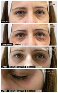 blefaroplastia con dermaplax