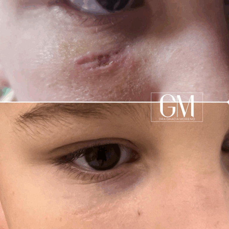 Antes y después cicatriz con exosomas