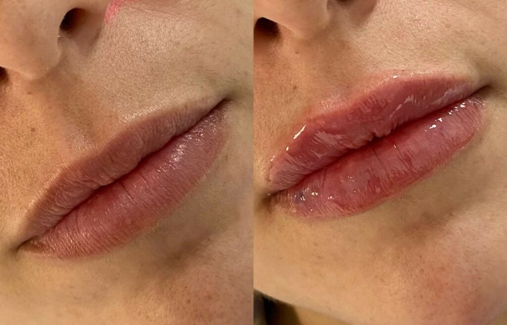 aumento labios acido hialuronico